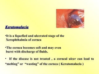 Keratomalacia
Keratomalacia
•It is a liquefied and ulcerated stage of the
Xerophthalmia of cornea
•The cornea becomes soft and may even
burst with discharge of fluids.
• If the disease is not treated , a corneal ulcer can lead to
“melting” or “wasting” of the cornea ( Keratomalacia )
 