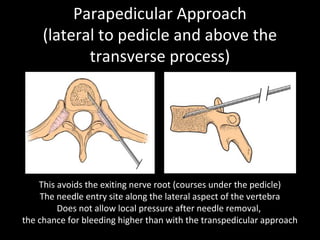 Technical aspects of percutaneous vertebroplasty & kyphoplasty | PPT