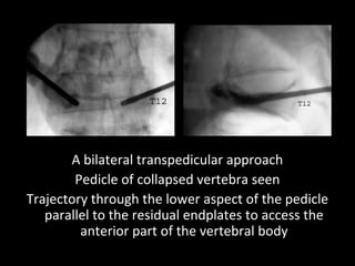 Technical aspects of percutaneous vertebroplasty & kyphoplasty | PPT