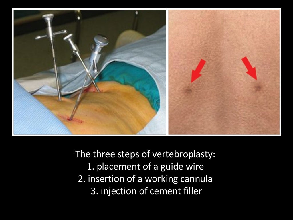 Technical aspects of percutaneous vertebroplasty & kyphoplasty