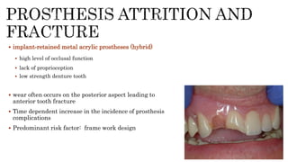  implant‐retained metal acrylic prostheses (hybrid)
 high level of occlusal function
 lack of proprioception
 low strength denture tooth
 wear often occurs on the posterior aspect leading to
anterior tooth fracture
 Time dependent increase in the incidence of prosthesis
complications
 Predominant risk factor: frame work design
 