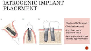  Too facially/ lingually
 Too shallow/deep
 too close to an
adjacent tooth
 two implants are too
closely approximated
 