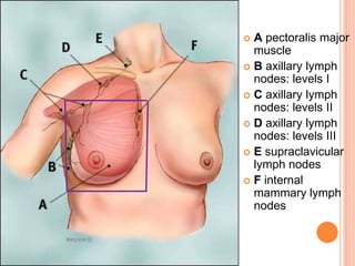  A pectoralis major
muscle
 B axillary lymph
nodes: levels I
 C axillary lymph
nodes: levels II
 D axillary lymph
nodes: levels III
 E supraclavicular
lymph nodes
 F internal
mammary lymph
nodes
 