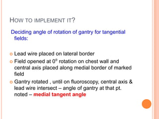 HOW TO IMPLEMENT IT?
Deciding angle of rotation of gantry for tangential
fields:
 Lead wire placed on lateral border
 Field opened at 0⁰ rotation on chest wall and
central axis placed along medial border of marked
field
 Gantry rotated , until on fluoroscopy, central axis &
lead wire intersect – angle of gantry at that pt.
noted – medial tangent angle
 