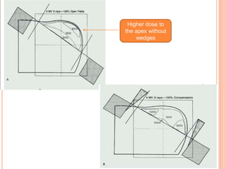 Higher dose to
the apex without
wedges
 