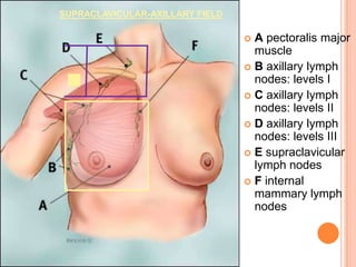  A pectoralis major
muscle
 B axillary lymph
nodes: levels I
 C axillary lymph
nodes: levels II
 D axillary lymph
nodes: levels III
 E supraclavicular
lymph nodes
 F internal
mammary lymph
nodes
SUPRACLAVICULAR-AXILLARY FIELD
 