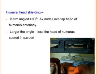 Humeral head shielding:–
• If arm angled >90⁰: Ax nodes overlap head of
humerus anteriorly.
• Larger the angle – less the head of humerus
spared in s.c port
 