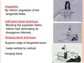 Angulation
By inferior angulation of the
tangential fields.
Half beam block technique
Blocking the supraclav field’s
inferior half, eliminating its
divergence inferiorly .
Hanging block technique
Superior edge of tangential beam
made vertical by vertical
hanging block.
 