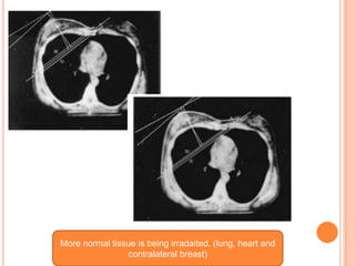 More normal tissue is being irradaited. (lung, heart and
contralateral breast)
 