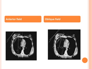 Anterior field Oblique field
 