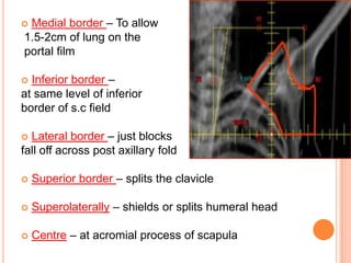  Medial border – To allow
1.5-2cm of lung on the
portal film
 Inferior border –
at same level of inferior
border of s.c field
 Lateral border – just blocks
fall off across post axillary fold
 Superior border – splits the clavicle
 Superolaterally – shields or splits humeral head
 Centre – at acromial process of scapula
 