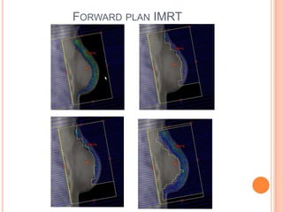 FORWARD PLAN IMRT
 