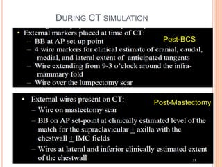 DURING CT SIMULATION
Post-BCS
Post-Mastectomy
 
