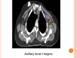 Axillary level I begins
 