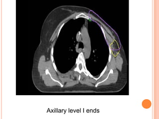 Axillary level I ends
 