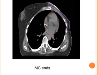 IMC ends
 