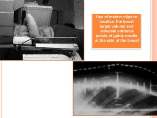 Use of marker clips to
localise the boost
target volume and
simulate entrance
points of guide needle
at the skin of the breast
 