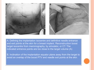 A. Defining the implantation isocentre and definitive needle entrance
and exit points at the skin for a breast implant. Reconstruction boost
target isocentre from mammography, by simulator, or CT. The
indicated entrance points are too close to the target volume (A)
B. Inclination of the implantation equator plane away from the target to
avoid an overlap of the boost PTV and needle exit points at the skin
 