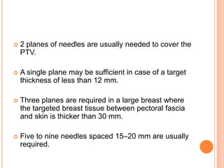  2 planes of needles are usually needed to cover the
PTV.
 A single plane may be sufficient in case of a target
thickness of less than 12 mm.
 Three planes are required in a large breast where
the targeted breast tissue between pectoral fascia
and skin is thicker than 30 mm.
 Five to nine needles spaced 15–20 mm are usually
required.
 