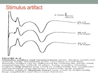 Stimulus artifact
 