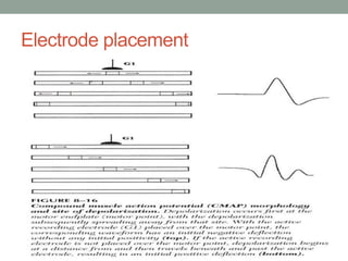 Electrode placement
 
