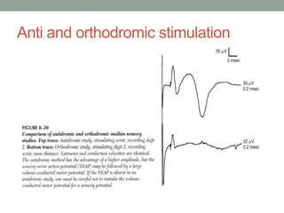 Anti and orthodromic stimulation
 