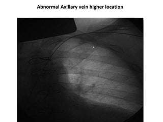 Technic venous access for permanent pacemaker implantation | PPTX