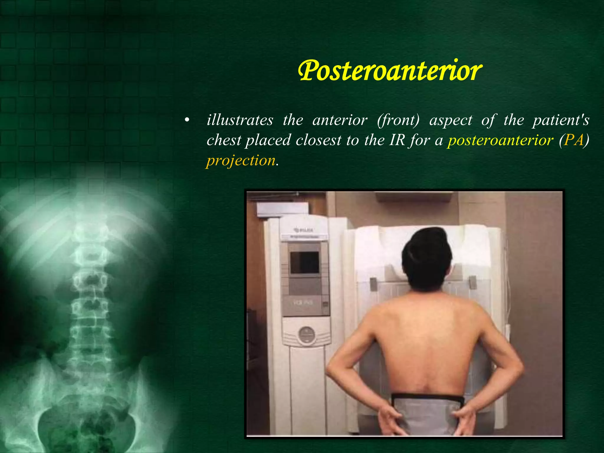 Posteroanterior
• illustrates the anterior (front) aspect of the patient's
chest placed closest to the IR for a posteroanterior (PA)
projection.
 