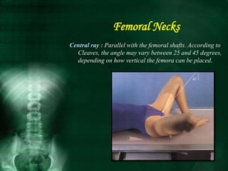 Central ray : Parallel with the femoral shafts. According to
Cleaves, the angle may vary between 25 and 45 degrees,
depending on how vertical the femora can be placed.
Femoral Necks
 