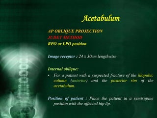 AP OBLIQUE PROJECTION
JUDET METHOD
RPO or LPO position
Image receptor : 24 x 30cm lengthwise
Internal oblique:
• For a patient with a suspected fracture of the iliopubic
column (anterior) and the posterior rim of the
acetabulum.
Position of patient : Place the patient in a semisupine
position with the affected hip lip.
Acetabulum
 