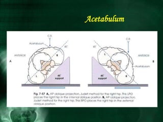 Acetabulum
 