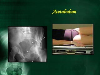 Acetabulum
 