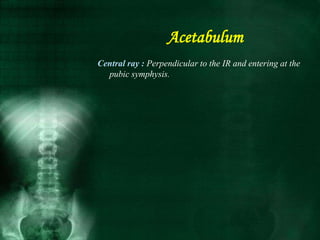 Central ray : Perpendicular to the IR and entering at the
pubic symphysis.
Acetabulum
 