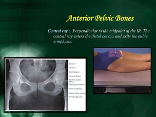 Central ray : Perpendicular to the midpoint of the IR. The
central ray enters the distal coccyx and exits the pubic
symphysis.
Anterior Pelvic Bones
 