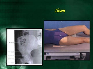 Ilium
 