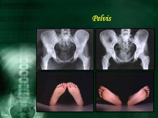 Pelvis
 