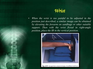 • When the wrist is too painful to be adjusted in the
position just described, a similar image can be obtained
by elevating the forearm on sandbags or other suitable
support. Then with the wrist flexed in right-angle
position, place the IR in the vertical position.
Wrist
 