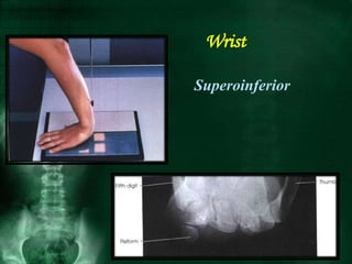 Wrist
Superoinferior
 