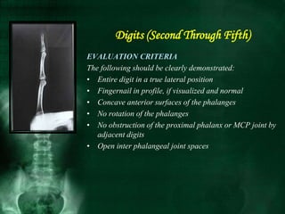 EVALUATION CRITERIA
The following should be clearly demonstrated:
• Entire digit in a true lateral position
• Fingernail in profile, if visualized and normal
• Concave anterior surfaces of the phalanges
• No rotation of the phalanges
• No obstruction of the proximal phalanx or MCP joint by
adjacent digits
• Open inter phalangeal joint spaces
Digits (Second Through Fifth)
 
