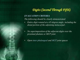 EVALUATION CRITERIA
The following should be clearly demonstrated:
• Entire digit rotated at a 45-degree angle, including the
distal portion of the adjoining metacarpal .
• No superimposition of the adjacent digits over the
proximal phalanx or MCP joint
• Open inter phalangeal and MCP joint spaces
Digits (Second Through Fifth)
 