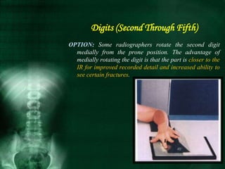 OPTION: Some radiographers rotate the second digit
medially from the prone position. The advantage of
medially rotating the digit is that the part is closer to the
IR for improved recorded detail and increased ability to
see certain fractures.
Digits (Second Through Fifth)
 
