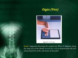 Lewis' suggested directing the central ray 10 to 15 degrees along
the long axis of the thumb toward the wrist to demonstrate the first
metacarpal free of the soft tissue of the palm.
Digits (First)
 