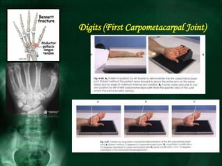 Digits (First Carpometacarpal Joint)
 