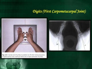 Digits (First Carpometacarpal Joint)
 