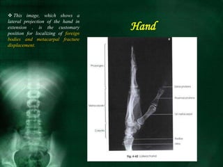 Hand
 This image, which shows a
lateral projection of the hand in
extension , is the customary
position for localizing of foreign
bodies and metacarpal fracture
displacement.
 