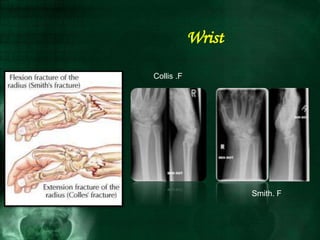 Smith. F
Collis .F
Wrist
 
