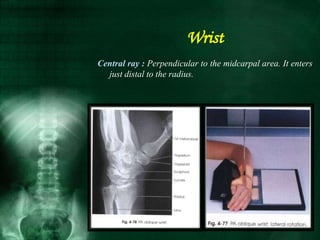 Central ray : Perpendicular to the midcarpal area. It enters
just distal to the radius.
Wrist
 