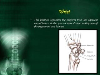 • This position separates the pisiform from the adjacent
carpal bones. It also gives a more distinct radiograph of
the triquetrum and hamate
Wrist
 
