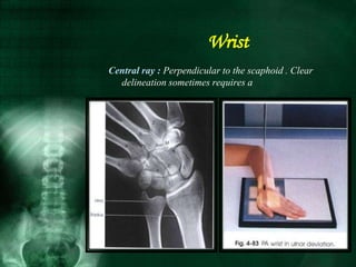 Central ray : Perpendicular to the scaphoid . Clear
delineation sometimes requires a
Wrist
 