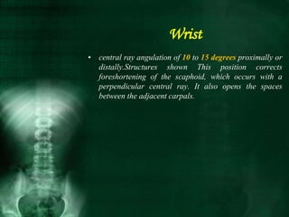 • central ray angulation of 10 to 15 degrees proximally or
distally.Structures shown This position corrects
foreshortening of the scaphoid, which occurs with a
perpendicular central ray. It also opens the spaces
between the adjacent carpals.
Wrist
 